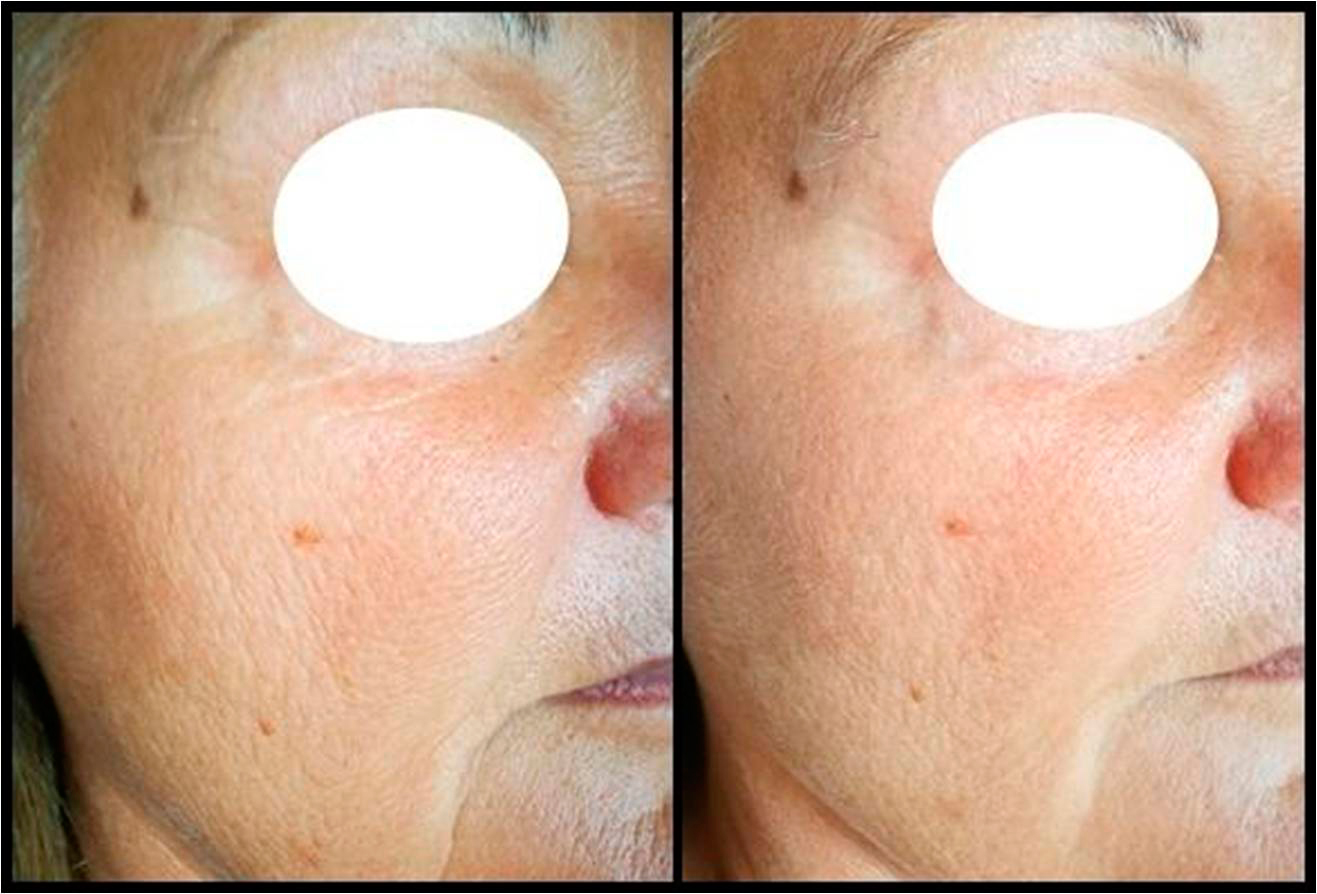 Биоревитализация кожи с эффектом пилинга в одной процедуре