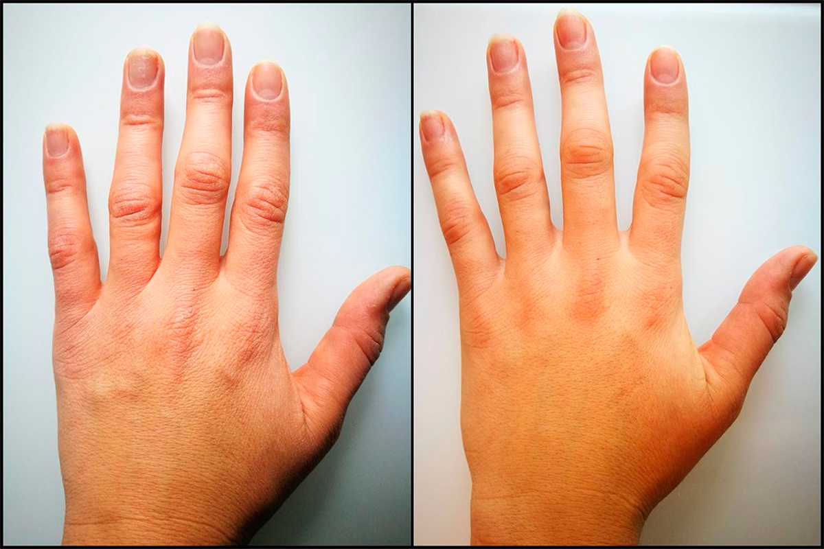Биоревитализация кожи с эффектом пилинга в одной процедуре